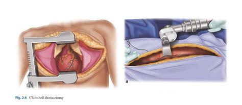 Image result for Clamshell Thoracotomy