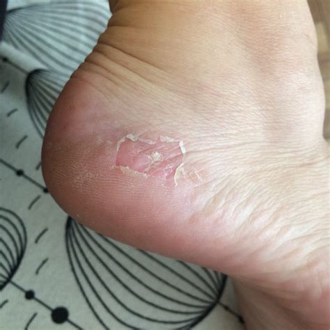 Sores on Bottom of Feet Causes, Symptoms and Treatments - American Celiac