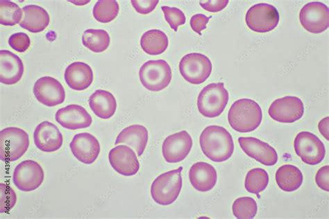 Target cells with abnormal red blood cells in blood smear, specimen from thalassemia patient ...