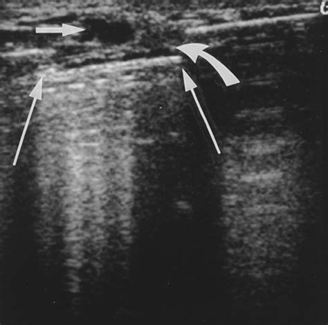 Incidental Treatment of Nipple Discharge Caused by Benign Intraductal ...