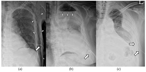 Double-pigtail Drainage Catheter: A New Design for Efficient Pleural ...