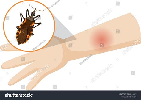735 Pictures Bug Bites Images, Stock Photos & Vectors | Shutterstock