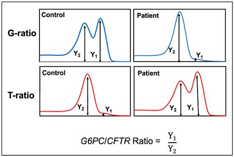 DBS Screening for Glycogen Storage Disease Type 1a: Detection of c.648G ...