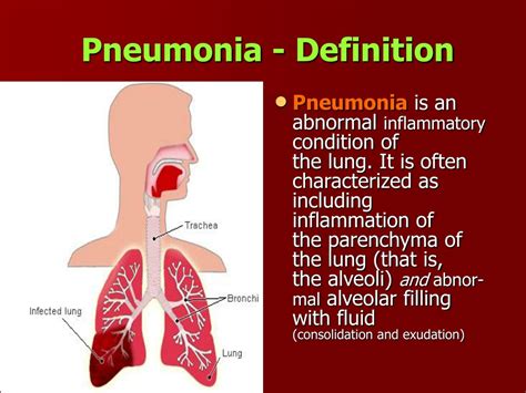 PPT - Community acquired pneumonia's PowerPoint Presentation, free ...