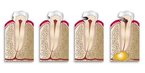 Cavities: The Ultimate Guide - Quarterpath Dental