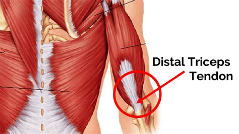 Triceps Tendonitis