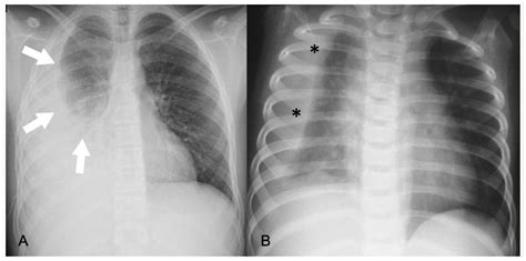 Imaging of Acute Complications of Community-Acquired Pneumonia in the ...