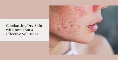 Combatting Dry Skin with Breakouts: Effective Solutions | Clinikally