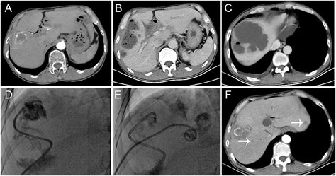Frontiers | The impact of liver abscess formation on prognosis of ...