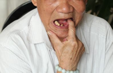 70岁老人牙齿掉光了怎么办？选择镶牙与种植牙哪个更好-蜜颜优惠
