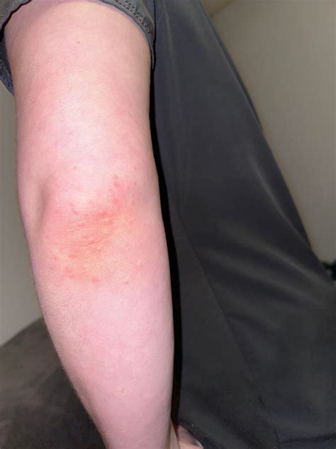 Why Are There Weird Bumps On My Elbow at Maria Baum blog