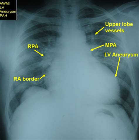 Cephalization Of Pulmonary Vessels