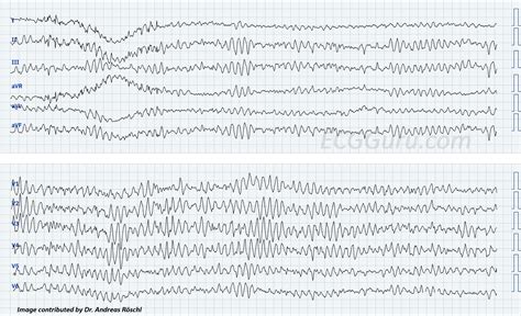 Ventricular fibrillation; V Fib | ECG Guru - Instructor Resources