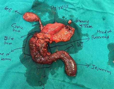 Laparoscopic / Minimally invasive Whipple surgery (pancreatico ...