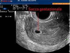 gestazionale senza embrione cause 5 settimane gestazionale senza embrione cause 5 settimane
