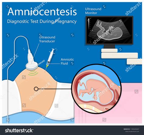 Chorionic Villus Sampling Vs Amniocentesis