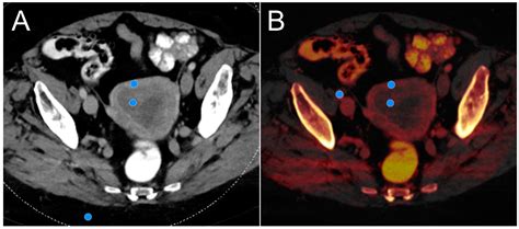 Preliminary Experience with Virtual Monoenergetic Imaging and Iodine ...