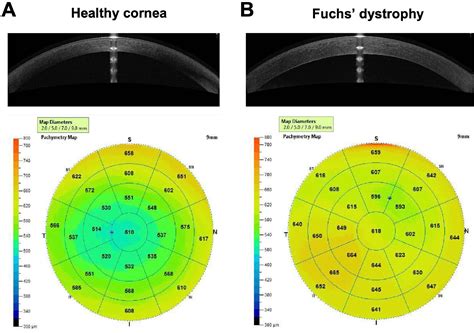 Detecting Subclinical Corneal Edema Using Corneal Thickness Mapping in Patients Presenting Fuchs ...