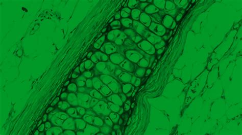 Transcript: Emerging biomarkers in CIDP - Medthority