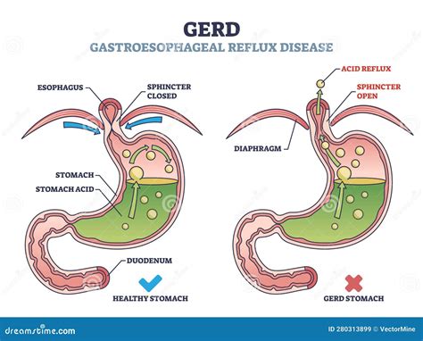 Gastroesophageal Reflux Disease Surgery – HQDRES