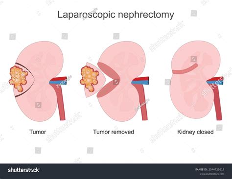 Image result for Nephrectomy Procedure