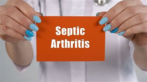Septic Arthritis (Infectious Arthritis): Symptoms, Causes, Diagnosis ...