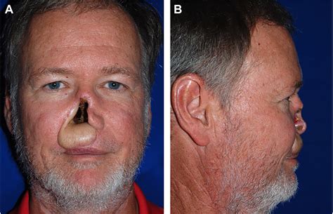 Total Nasal Reconstruction - Facial Plastic Surgery Clinics