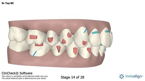 Image result for Invisalign ClinCheck
