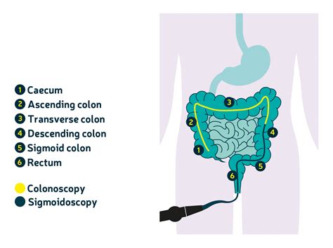 Hospital tests and colonoscopies | Bowel Cancer UK | Bowel Cancer UK
