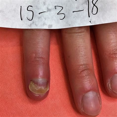 Successfully Repairing Damaged Finger Nail Bed
