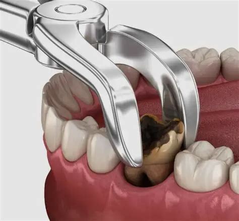 Image result for Getting Tooth Removed