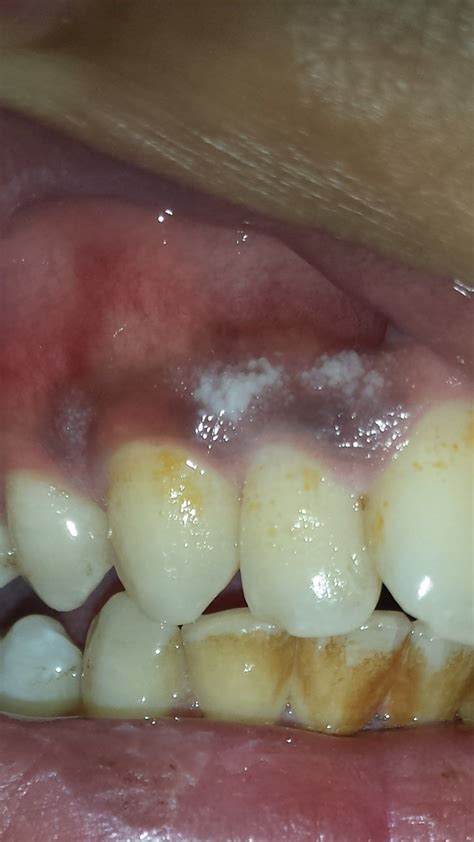 Cause of White gums - MEDizzy