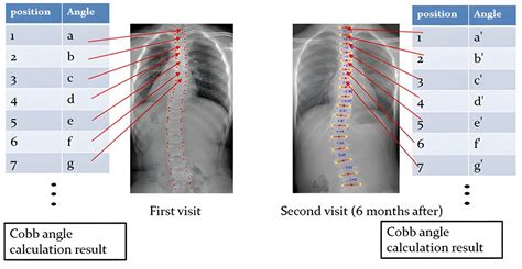 Deep Learning-Based Prediction Model for the Cobb Angle in Adolescent ...