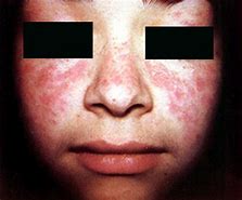 Image result for Systemic Lupus Erythematosus Symptoms