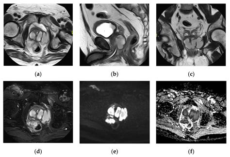 Perianal Abscess Mri