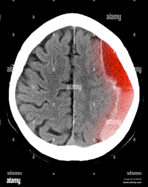 CT scan of the head showing a subdural hematoma Stock Photo, Royalty ...