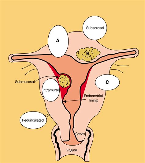 Uterine fibroids - The Lancet