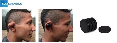 Bildergebnis für is cauliflower ear permanent