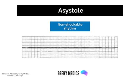 Fine Ventricular Fibrillation Vs Asystole Asystole: Background,