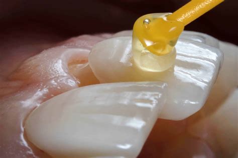 How Much Do Porcelain Veneers Cost in NYC?