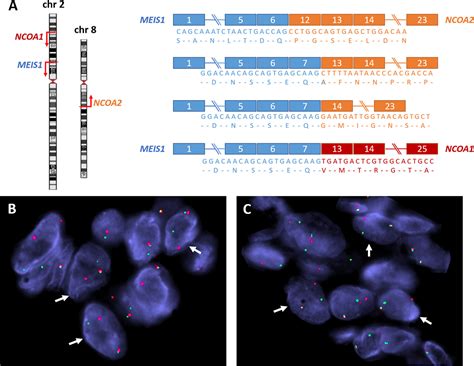 Recurrent MEIS1-NCOA2/1 fusions in a subset of low-grade spindle cell ...