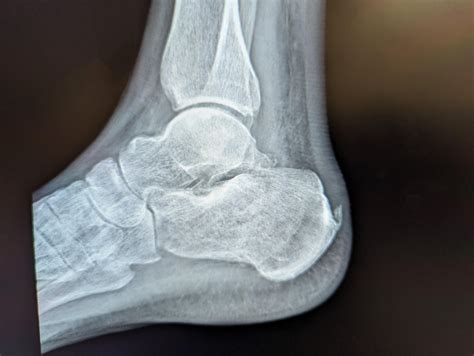 sclerotic vs lytic bone lesion on xray : r/Radiology