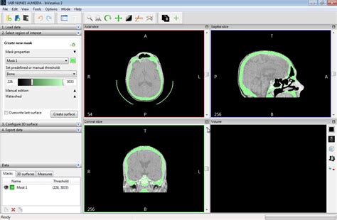 InVesalius Tutorial 的图像结果