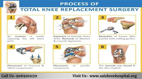 Steps To Knee Replacement Surgery