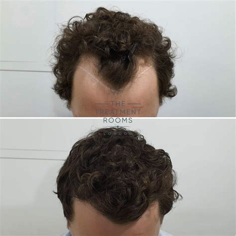 What Is A Widow's Peak? | The Treatment Rooms London