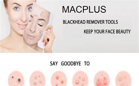 MACPLUS 4Pcs Blackhead Pimple Golden Remover Tools for Professional ...