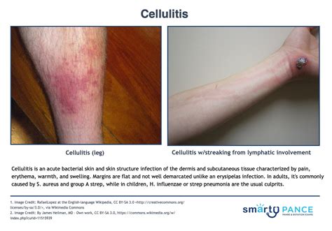 Strep Vs Staph Cellulitis