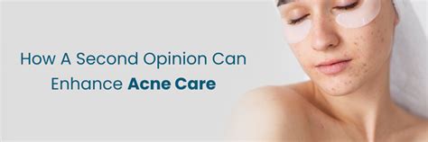 Know How Second Opinion Enhances Acne Care - Call Now!