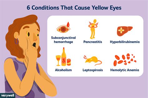 Yellow Eyes: Causes, Diagnosis, and Treatment