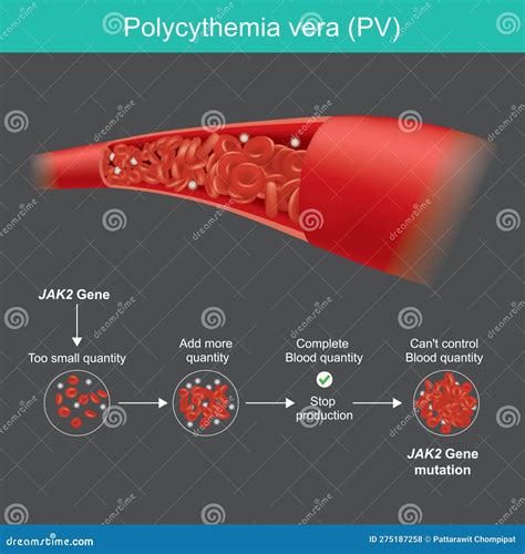 Polycythemia Vera, A Rare Slow-growing Blood Cancer With An Increase In The Number Of Red Blood ...